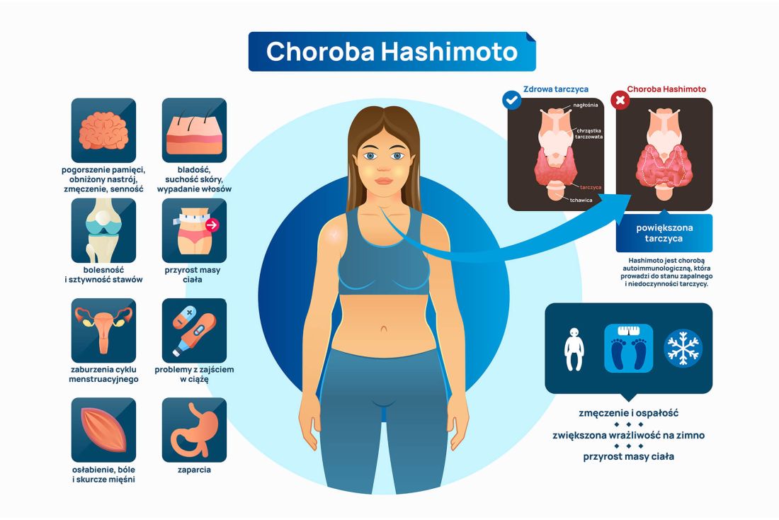 objawy choroby Hashimoto infografika