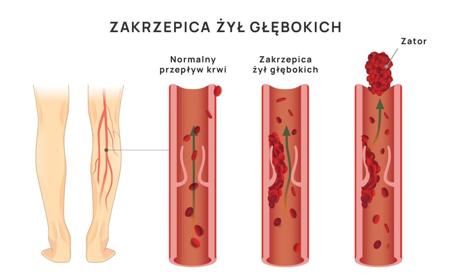 zakrzepica żył głębokich infografika