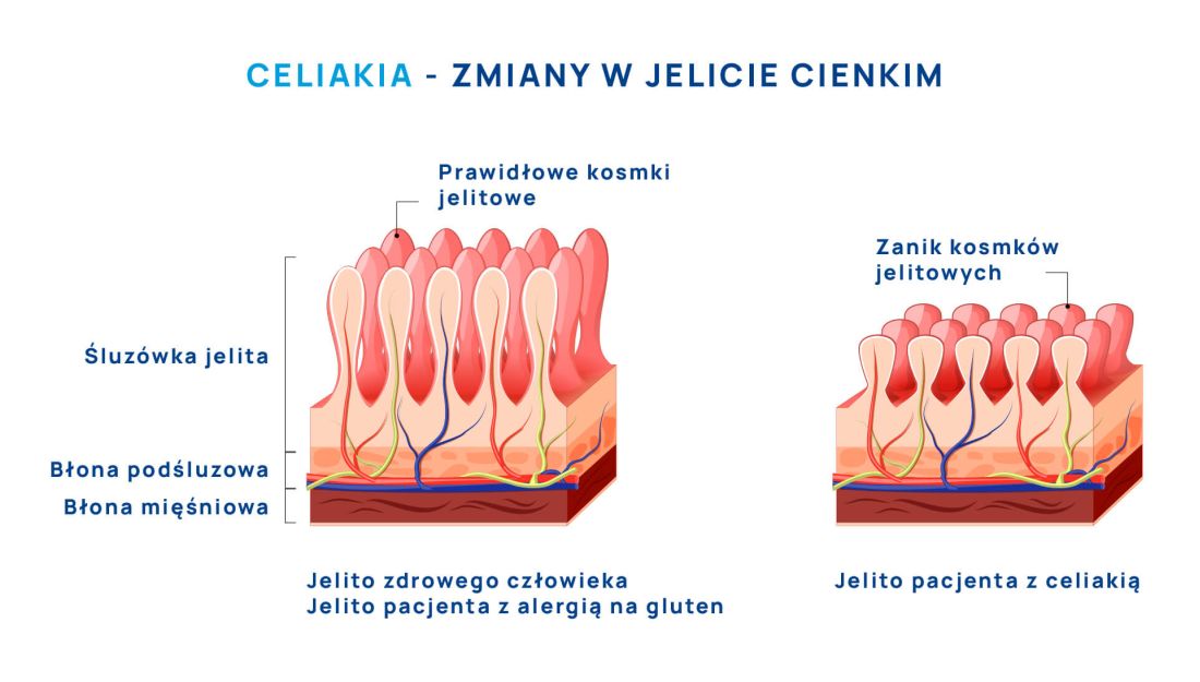 celiakia zmiany w jelicie cienkim infografika