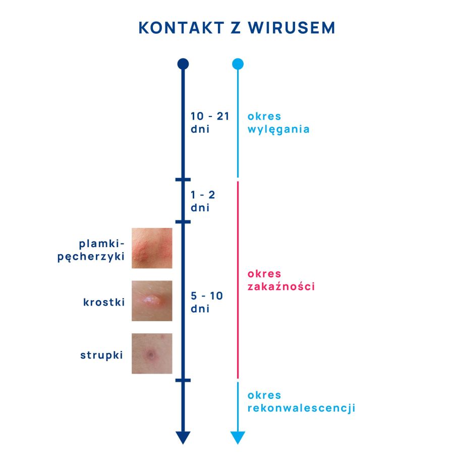 przebieg i czas trwania ospy wietrznej i okres zakaźności infografika