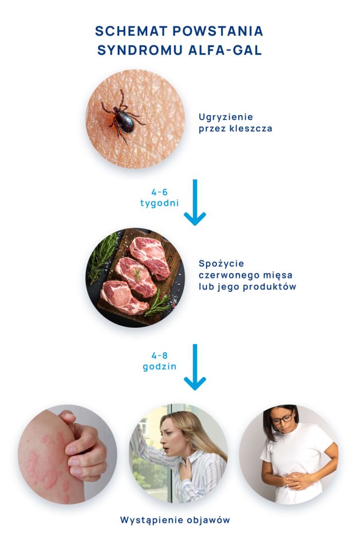 jak powstaje syndrom alfa-gal - infografika