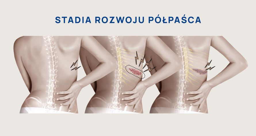 stadia rozwoju półpaśca infografika