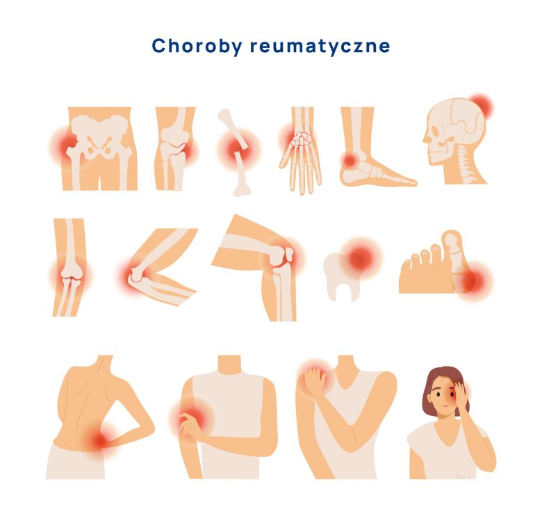 choroby reumatyczne infografika