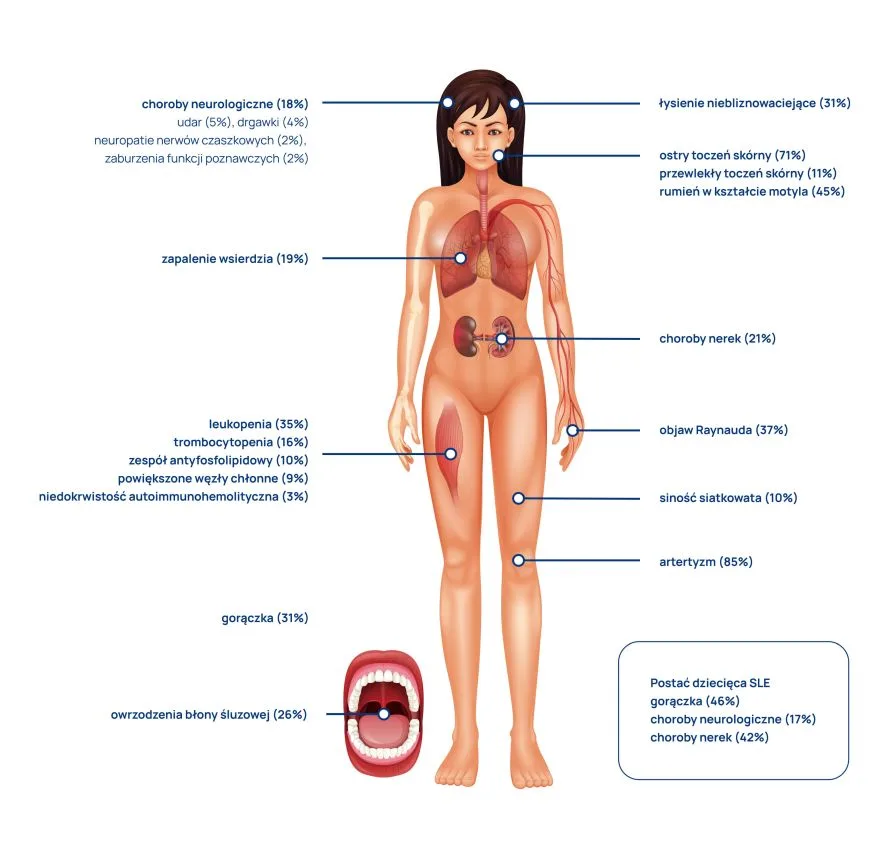 kliniczne postacie tocznia układowego infografika