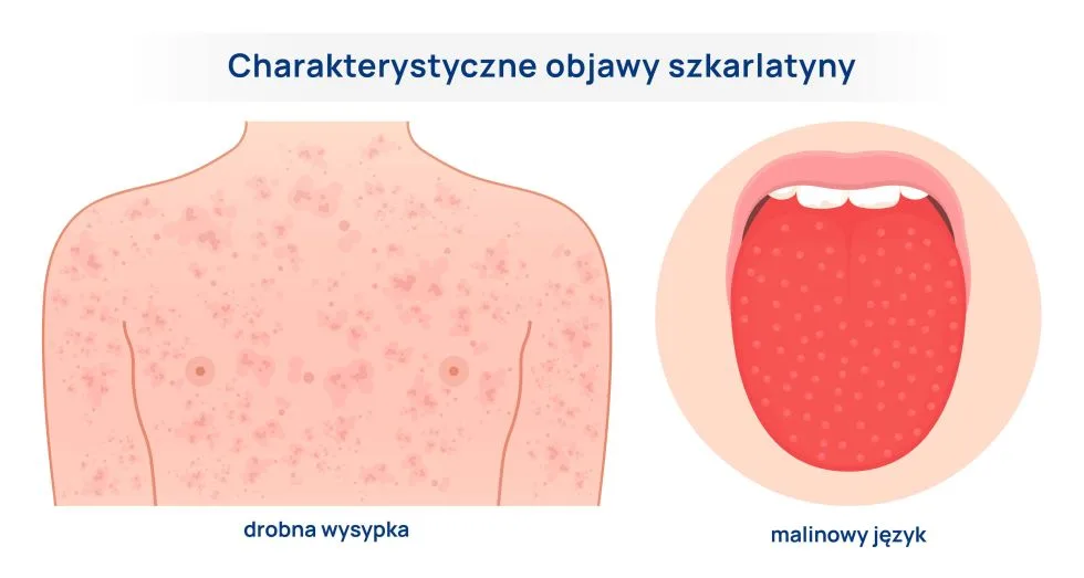 objawy szkarlatyny infografika