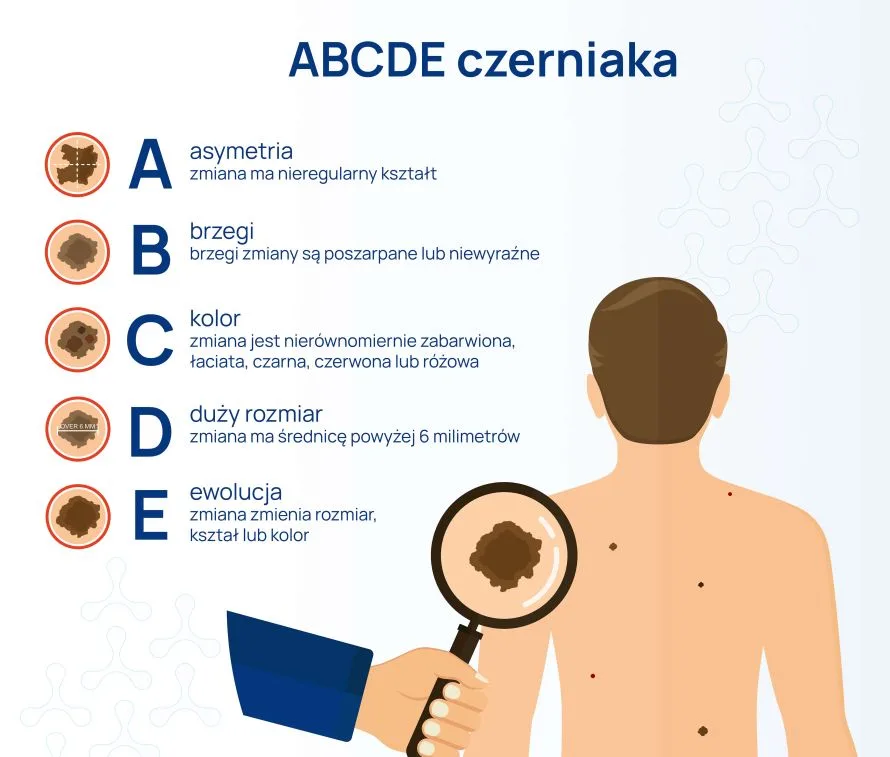 abcde czerniaka infografika