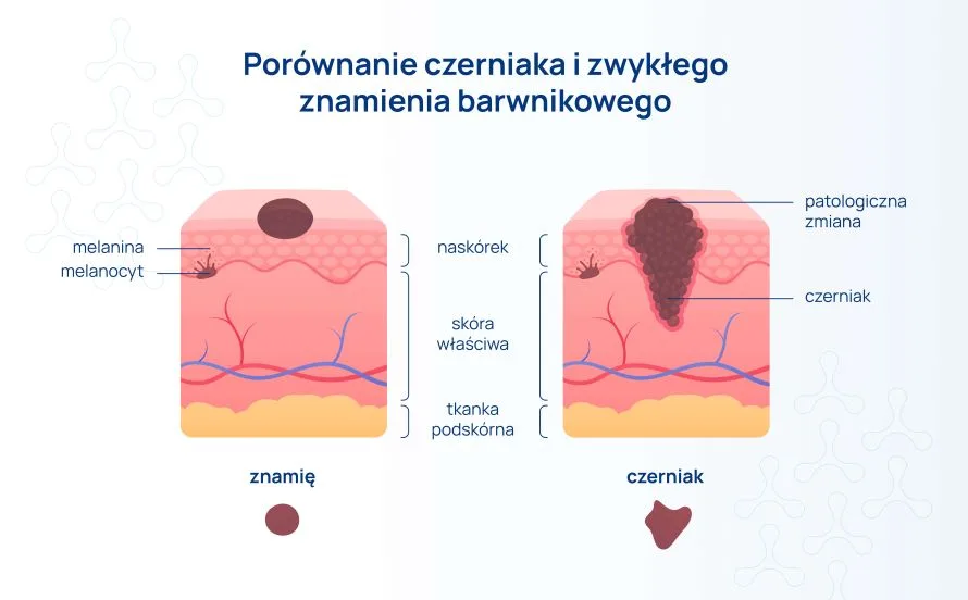 porównanie czerniaka i zwykłego znamienia barwnikowego infografika