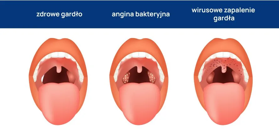 angina wygląd gardła infografika