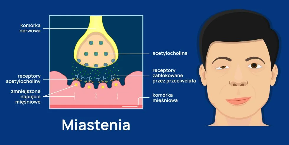 miastenia infografika