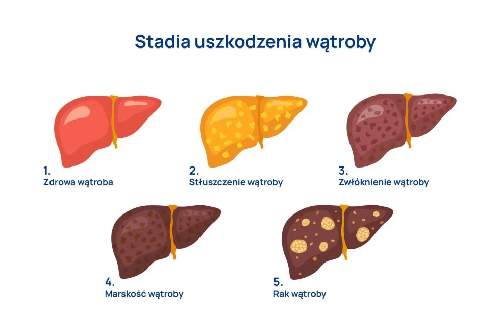 stadia uszkodzenia wątroby