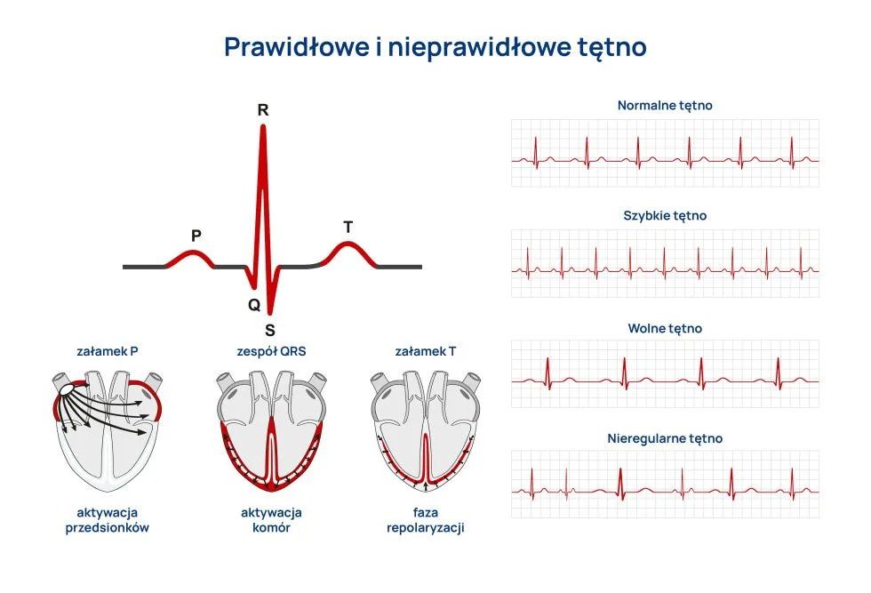 EKG nadciśnienie infografika