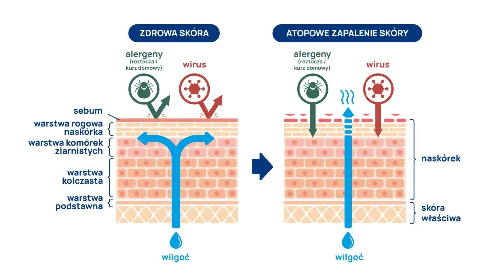 atopowe zapalenie skóry infografika