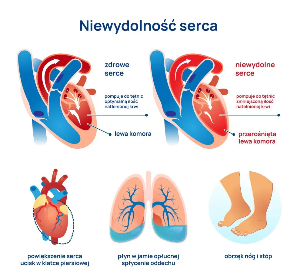 niewydolność serca infografika