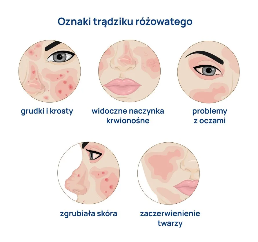 objawy trądziku różowatego infografika