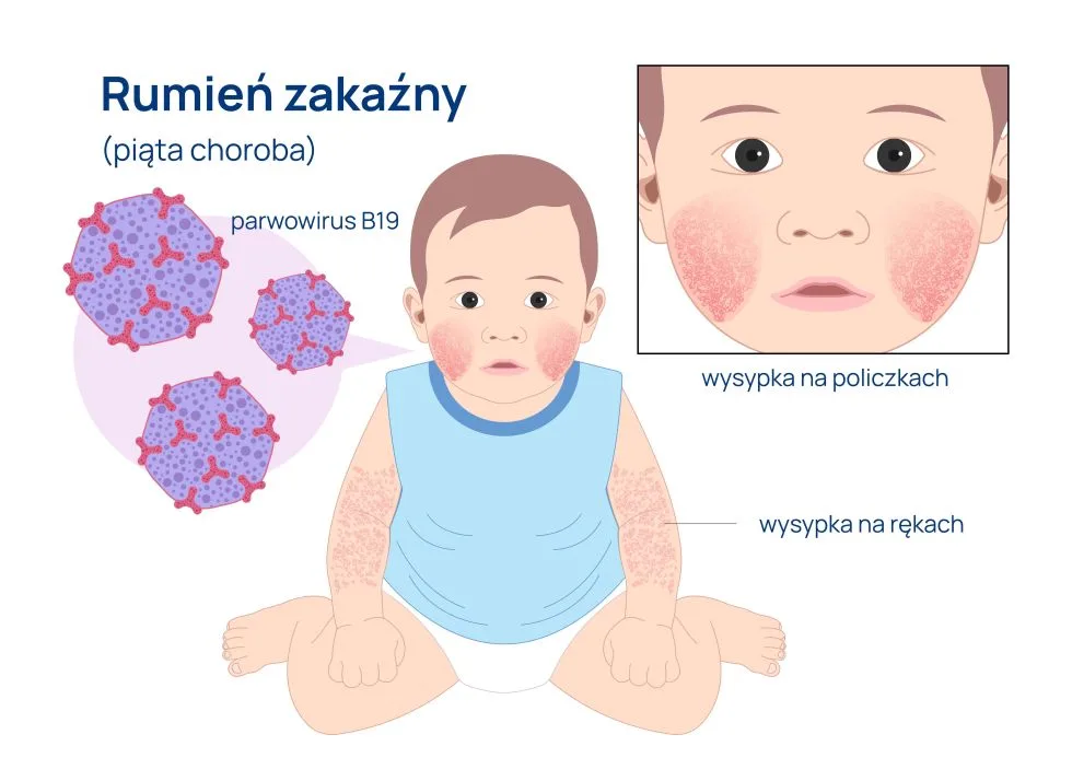 rumień zakaźny (piąta choroba) objawy lokalizacja wysypki infografika