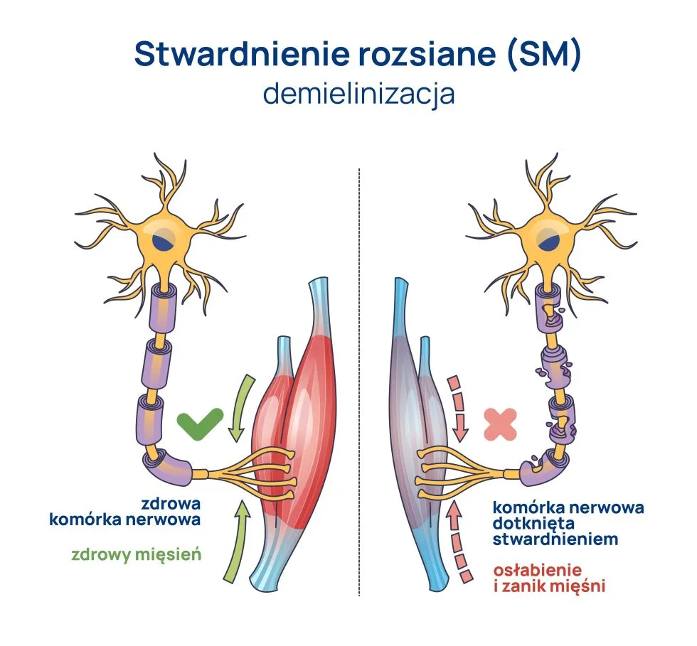 stwardnienie rozsiane demielinizacja infografika