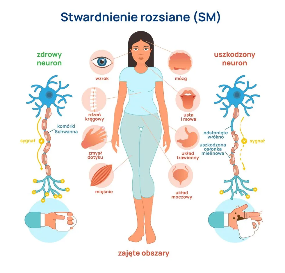 stwardnienie rozsiane objawy infografika