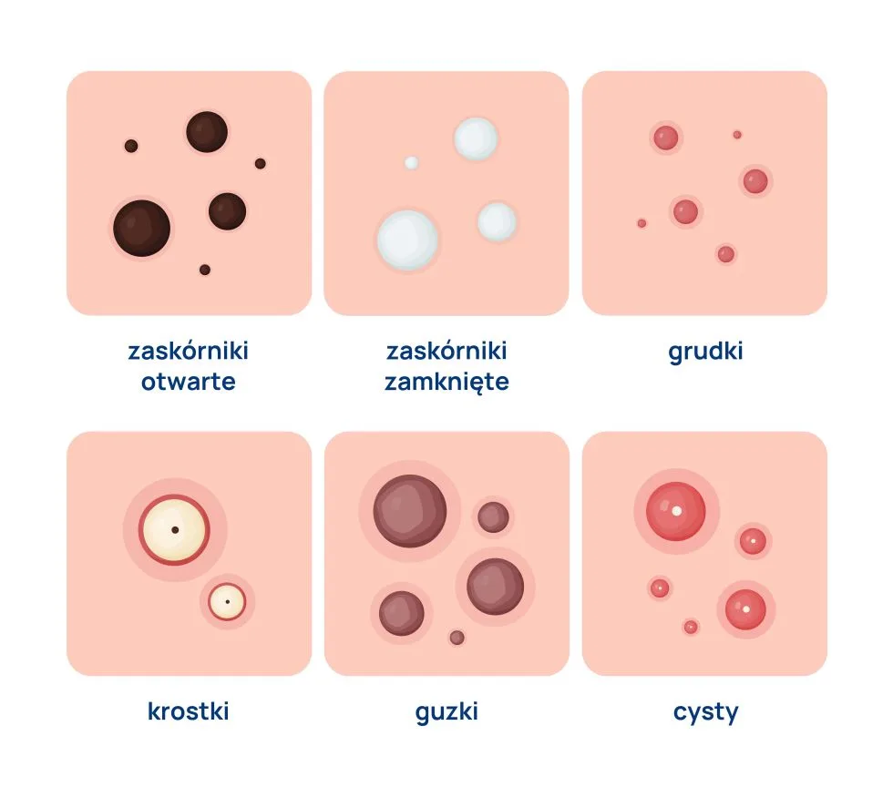 trądzik dorosłych infografika