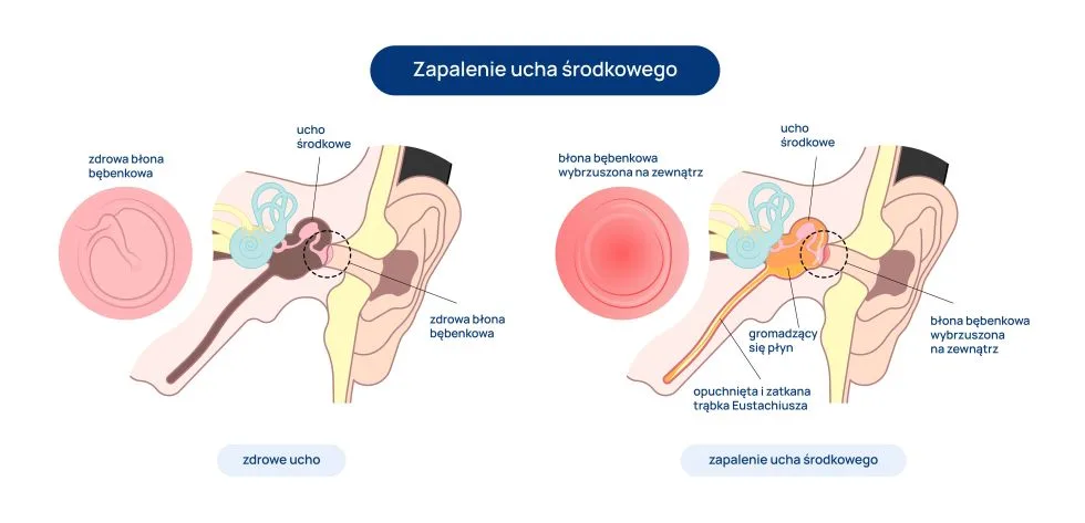 zapalenie ucha środkowego infografika