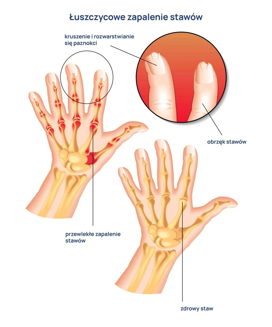 łuszczycowe zapalenie stawów infografika