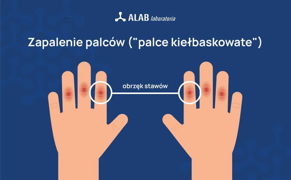 zapalenie palców (palce kiełbaskowate) w łuszczycowym zapaleniu stawów infografika