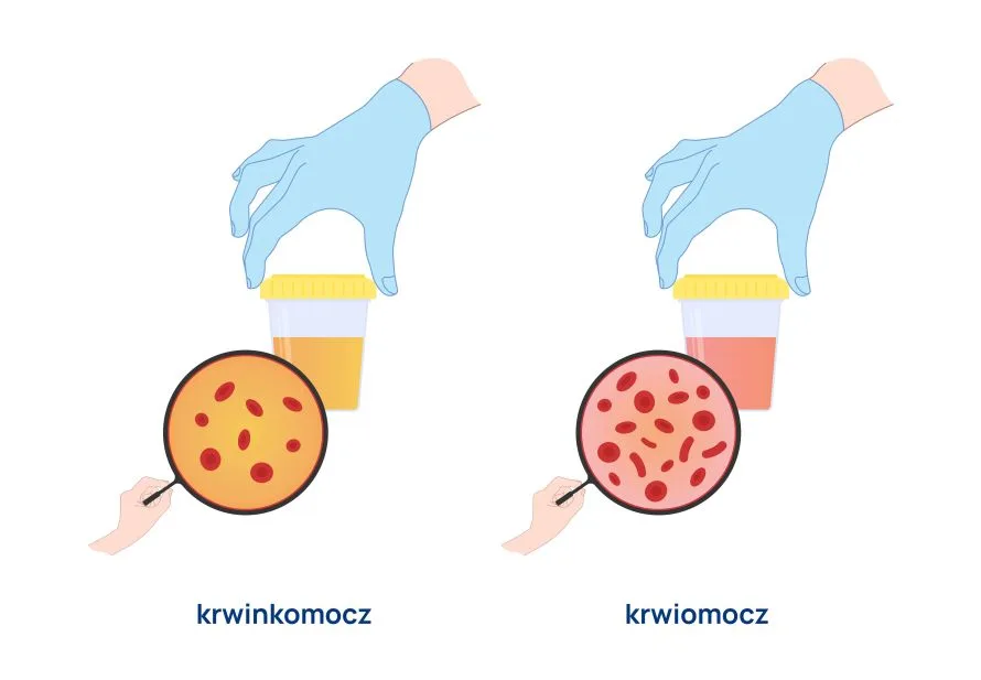 Różnica między krwinkomoczem a krwiomoczem infografika