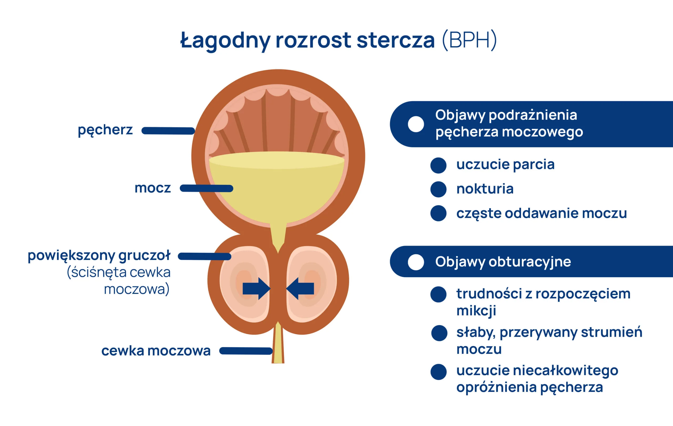 lagodny przerost prostaty infografika