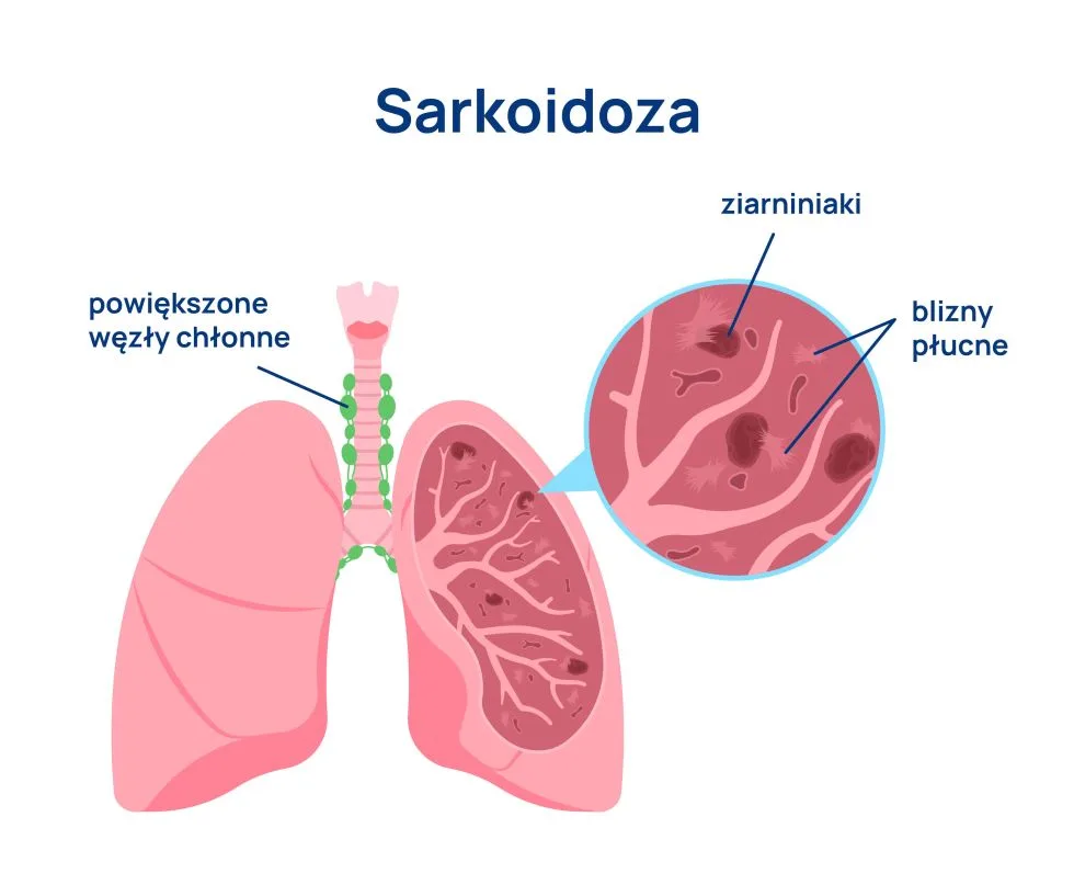 Sarkoidoza infografika