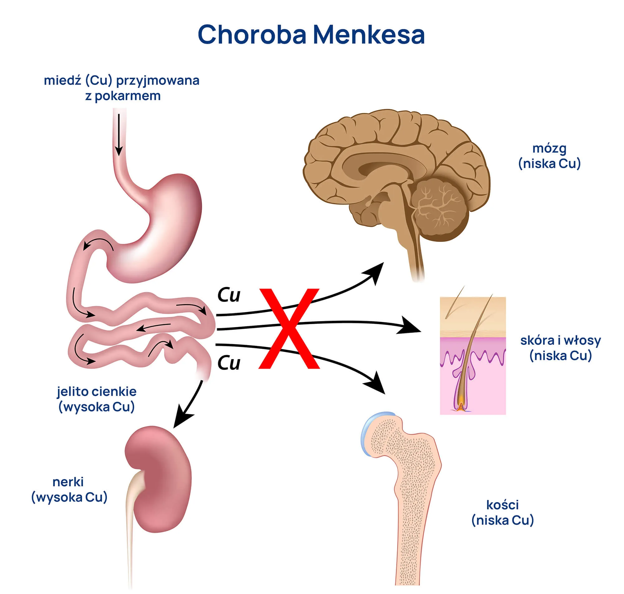 ceruloplazmina infografika choroba Menkesa