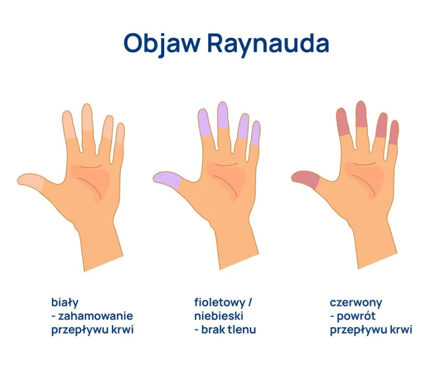 objaw Raynuada infografika