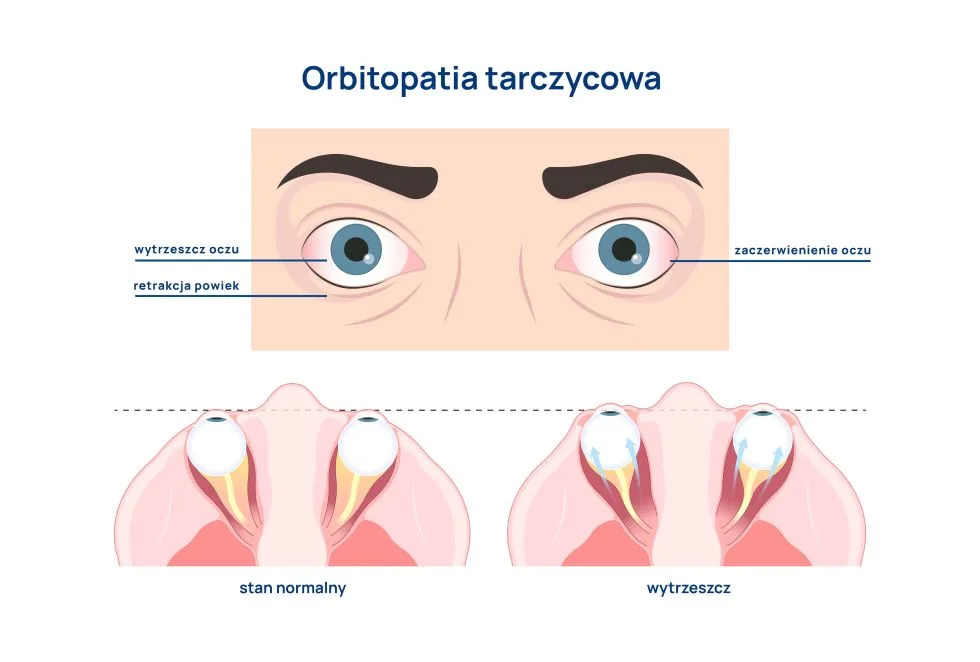 orbitopatia tarczycowa infografika