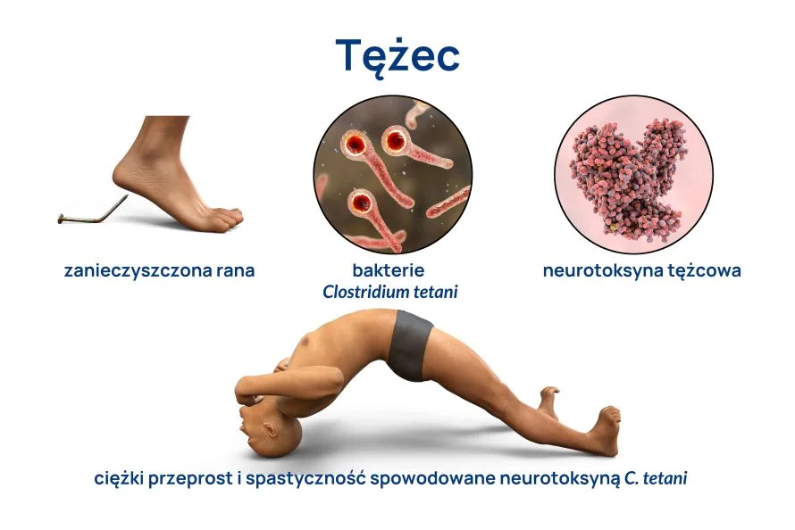 tężec infografika