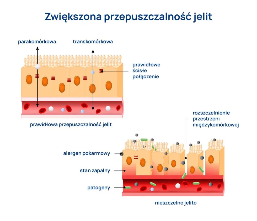 zwiększona przepuszczalność jelit infografika