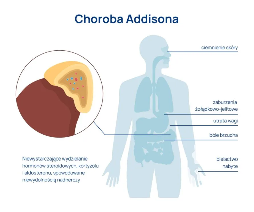 choroba Addisona infografika