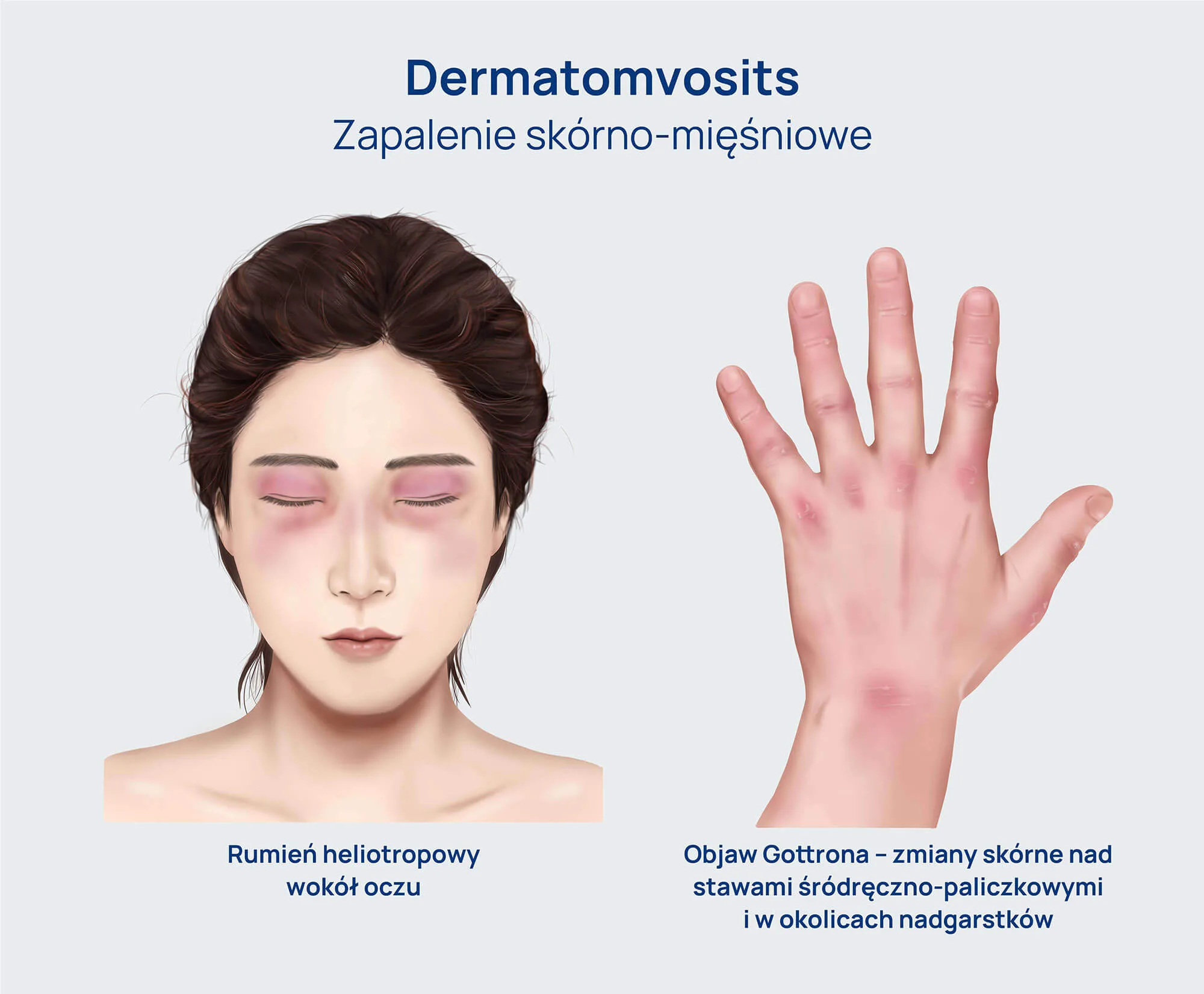 Miopatie_zapalne_infografika