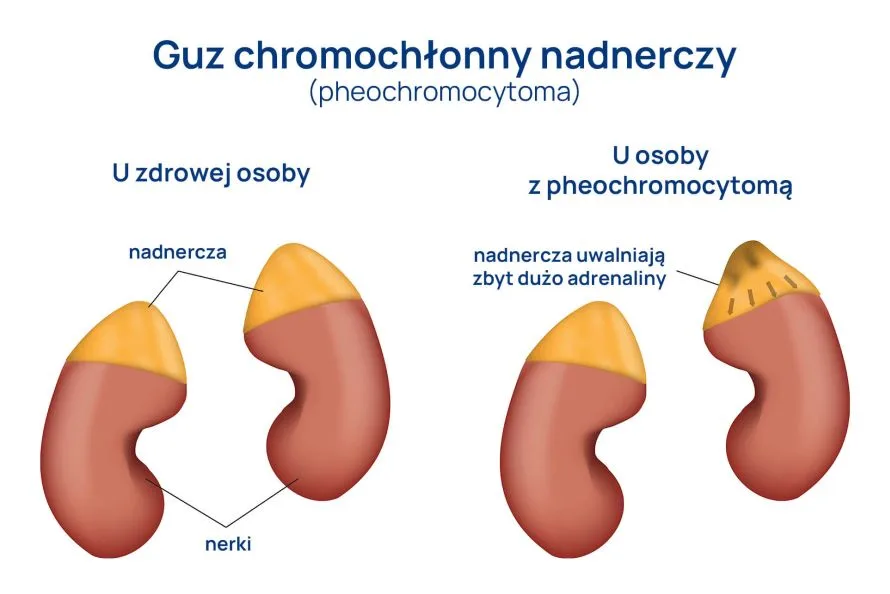 Guz_chromochłonny_nadnerczy_infografika