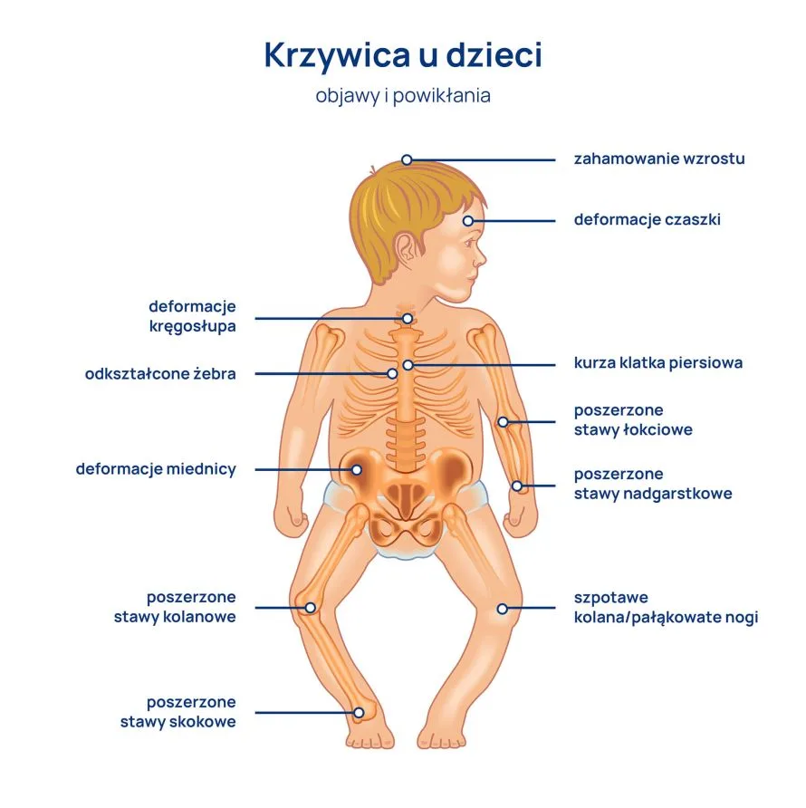 krzywica objawy i powikłania infografika