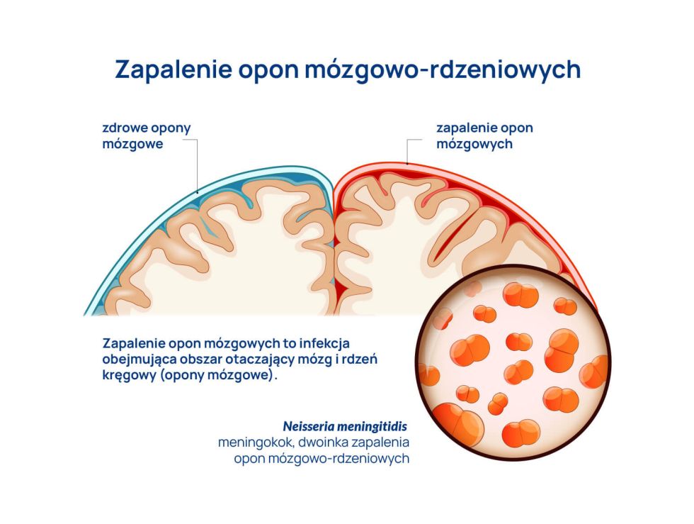 Zapalenie opon mózgowych u dzieci_infografika