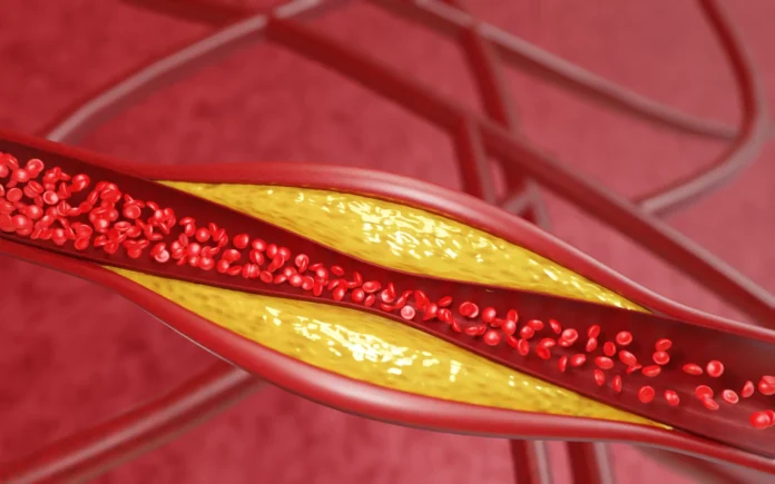 cholesterol ldl