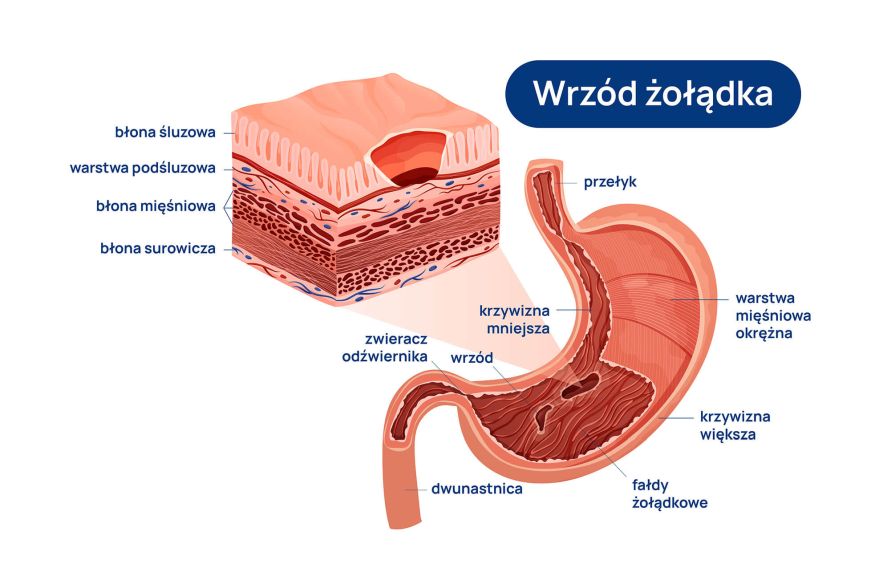 Wrzody_żołądka_infografika_2