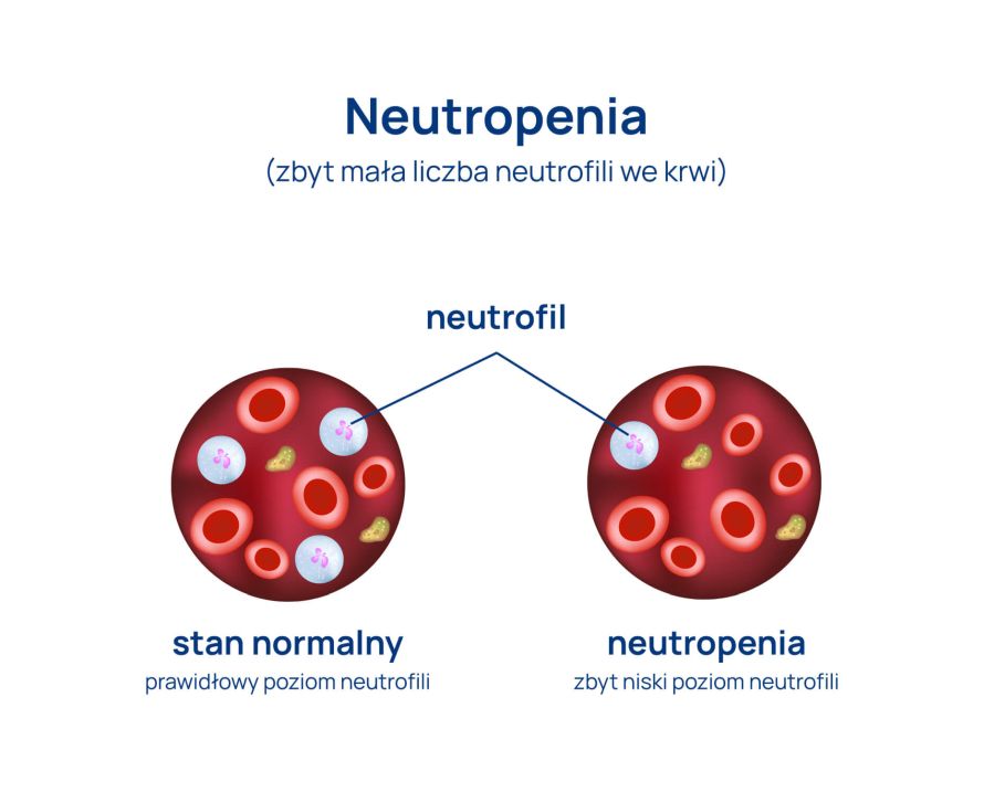 Neutropenia_infografika