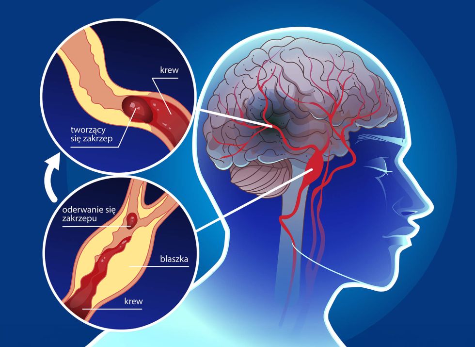 udar niedokrwienny mózgu infografika